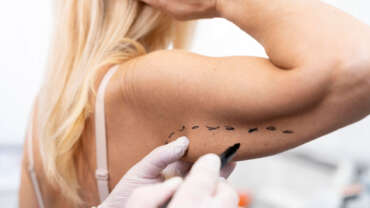 Brachioplasty