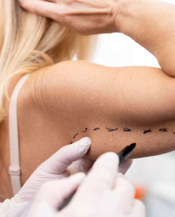 Brachioplasty