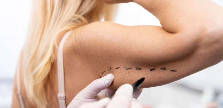 Brachioplasty