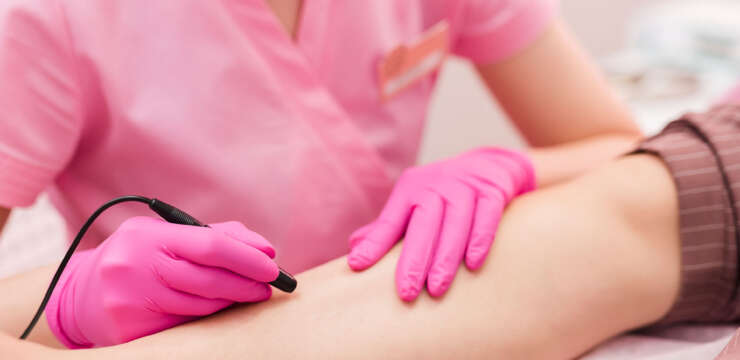 Spider Vein Treatment