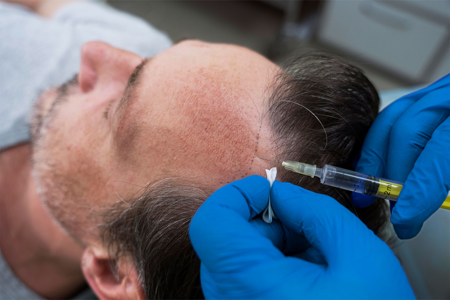 Platelet-Rich Plasma (PRP)