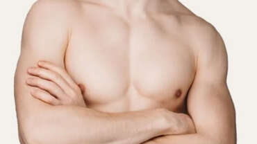 Gynaecomastia