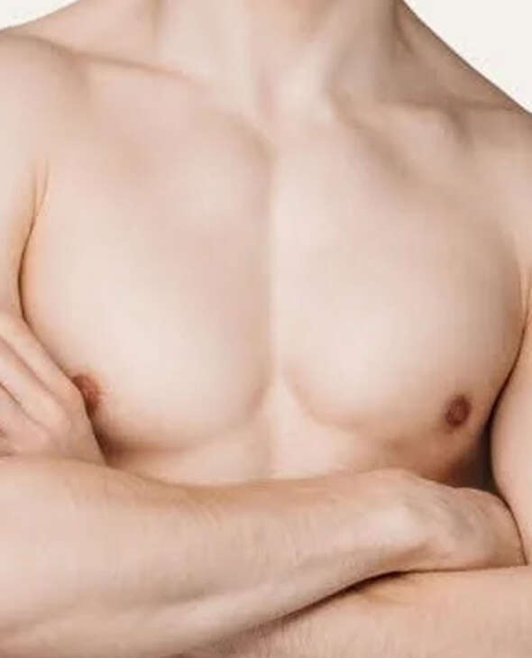 Gynaecomastia