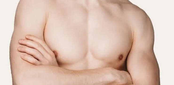 Gynaecomastia