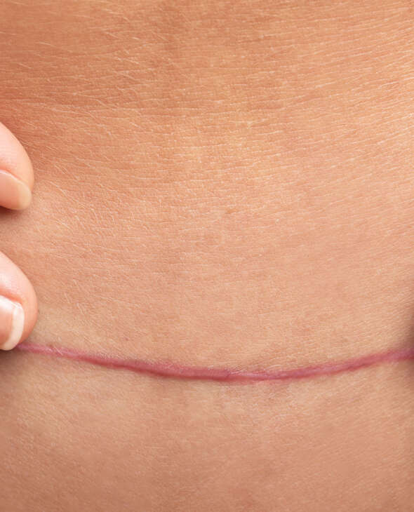 Scar Treatment