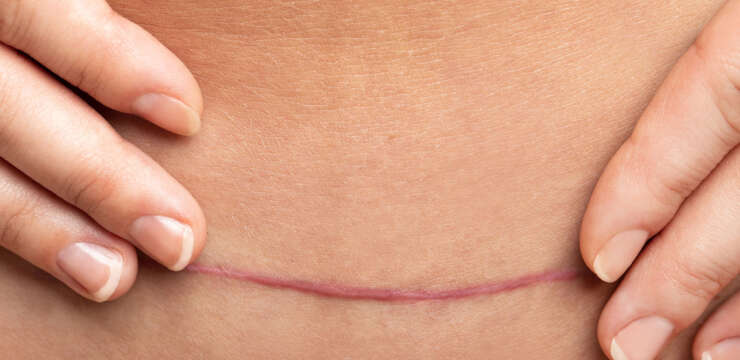 Scar Treatment